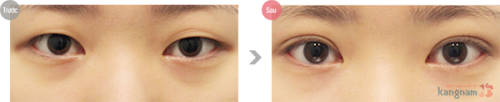 kết quả bấm mắt 2 mí không phẫu thuật tại Kangnam kết quả bấm mắt 2 mí không phẫu thuật tại Kangnam