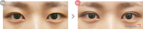 Bạn gái chia sẻ bấm mắt 2 mí không phẫu thuật tại Kangnam mang lại kết quả thế nào? Kết quả bấm mắt hai mí không phẫu thuật tại Kangnam