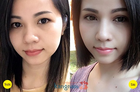 Trước và sau khi khách hàng cắt mí mắt tại thẩm mỹ viện kangnam