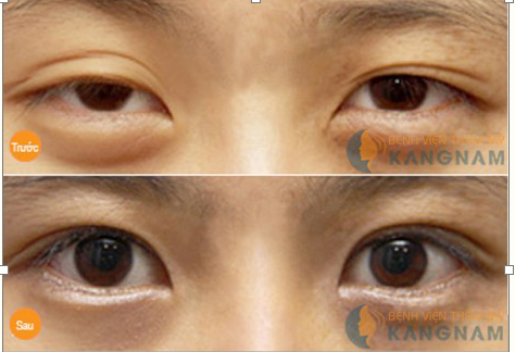 Chia sẻ kinh nghiệm cắt bọng mắt thành công tại Kangnam 1