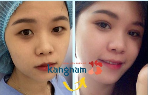 Kết quả hình ảnh cho site:bammihanquoc.vn cắt mắt 2 mí