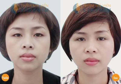 dich-vu-nhan-mi-mat-dove-eyes-o-dau-re-nhat3