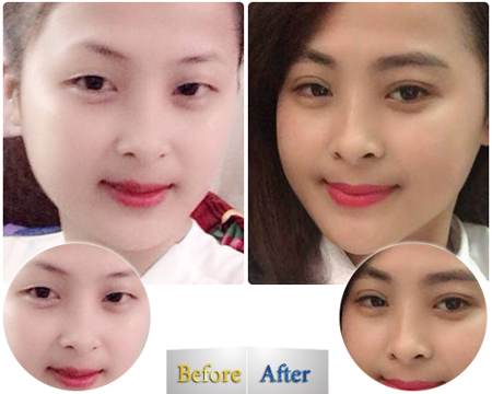 Bấm mí Kangnam555