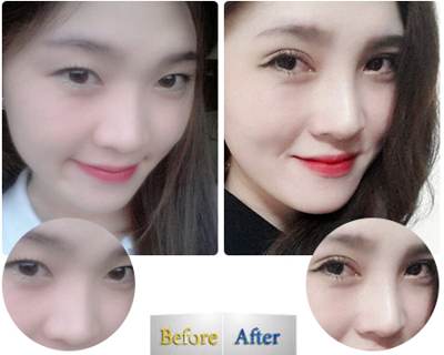 Bấm mí Kangnam68
