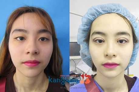 BẤM MÍ MẮT DOVE EYES - MẮT 2 MÍ HÚT HỒN CHỈ SAU 20 PHÚT6