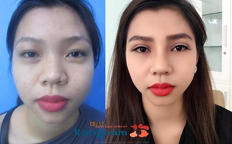 BẤM MÍ MẮT DOVE EYES - MẮT 2 MÍ HÚT HỒN CHỈ SAU 20 PHÚT5