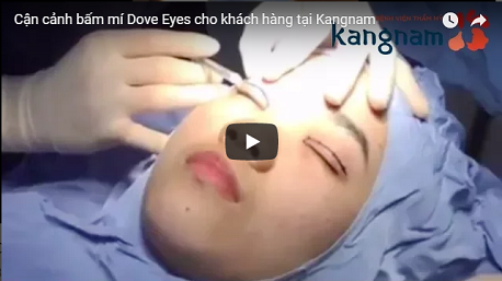 Bấm mí mắt Dove Eyes - Thủ thuật đơn giản giúp mắt đẹp long lanh