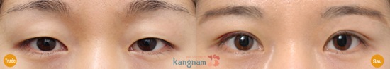  Bấm mí ở đâu đẹp Sài Gòn? - mối quan tâm hàng đầu của các chị em