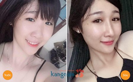  Bấm mí ở đâu đẹp Sài Gòn? - Tư vấn từ chuyên gia thẩm mỹ