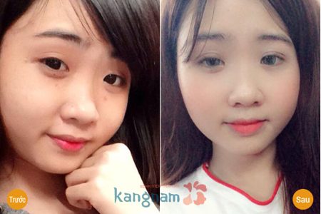 Bấm mí mắt ở đâu đẹp nhất Sài Gòn - Cùng lắng nghe các chuyên gia chia sẻ