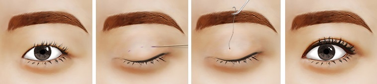Sự khác biệt trong quy trình cắt mí và bấm mí mắt