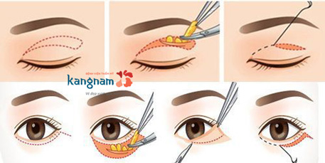 Có nên nhấn mí không 20