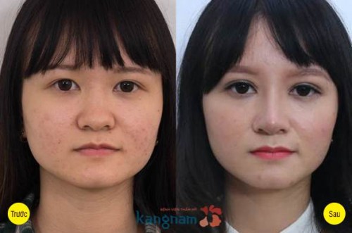Kết quả khắc phục mắt lệch tại Kangnam