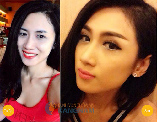Trẻ lại 10 tuổi sau 1 lần cắt mí – Chia sẻ của chị Phương My