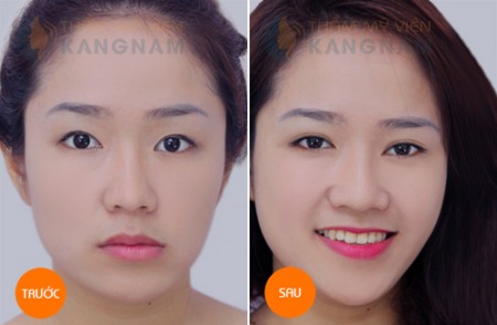 bấm mí hàn quốc