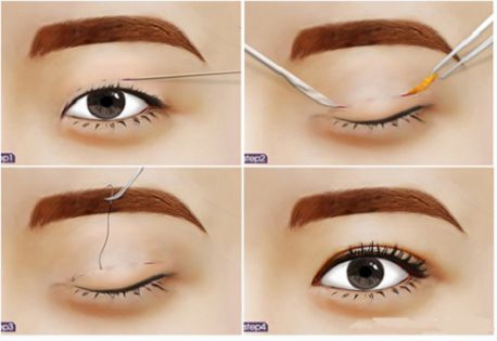 BẤM MÍ MẮT DOVE EYES - MẮT 2 MÍ HÚT HỒN CHỈ SAU 20 PHÚT3
