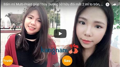 Bấm mí mắt vĩnh viễn và những điều cần biết8