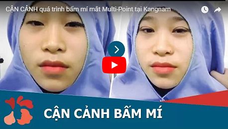 Bấm mí mắt vĩnh viễn và những điều cần biết3