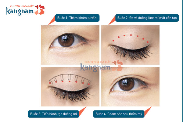bấm mí mắt MultiPoint tại Kangnam