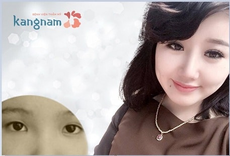 Giải pháp tạo mắt 2 mí bằng phương pháp Multi Point