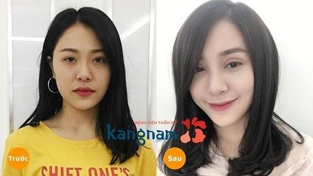 Giải pháp tạo mắt 2 mí bằng bấm mí Multi Point5