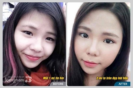 Giải pháp tạo mắt 2 mí tốt nhất bằng bấm mí Multi Point5