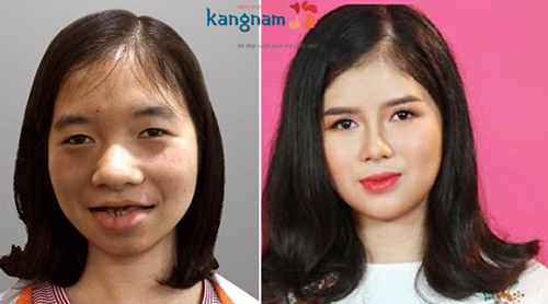 Cô gái trẻ hoàn toàn "lột xác" sau phẫu thuật thẩm mỹ tại Kangnam