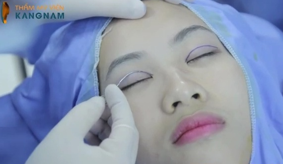 Bấm mí Hàn Quốc giúp tạo đôi mắt hai mí đều đẹp