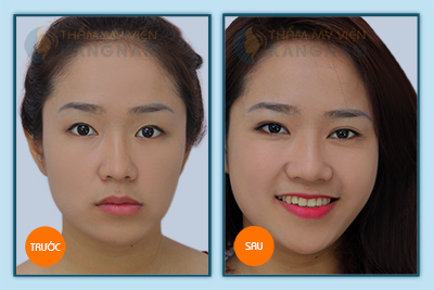 Cách tạo mắt hai mí đều đẹp và vĩnh viễn