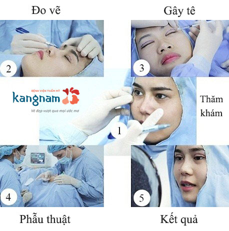 Cảnh báo rủi ro từ keo dán, chỉ kích mí tạo mắt 2 mí