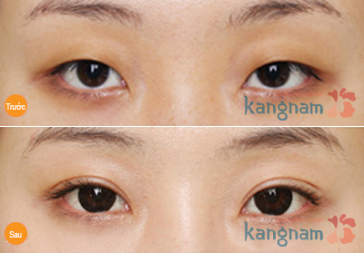 Kết quả thẩm mỹ mắt mắt to của khách hàng tại Kangnam1