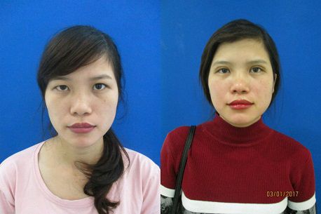 Có nên thẩm mỹ mắt to mắt nhỏ không 5