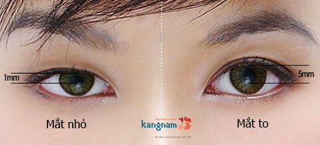 Có nên thẩm mỹ mắt to mắt nhỏ không 4