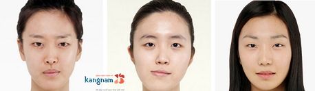 Có nên thẩm mỹ mắt to mắt nhỏ không 3