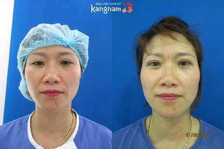 Có nên thẩm mỹ mắt to mắt nhỏ không 6