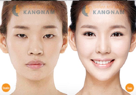 Kết quả khắc phục mắt lươn tại Kangnam