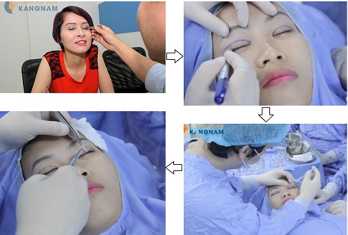Quy trình khắc phục mắt lươn tại Kangnam