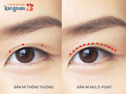 Khuyến mại bấm mí mắt đa điểm tại bệnh viện thẩm mỹ kangnam