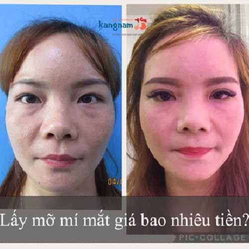 Lấy mỡ mí mắt giá bao nhiêu tiền? Bảng giá lấy mỡ bọng mắt ở Kangnam.