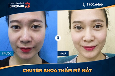 nhấn mí bị bầm tím