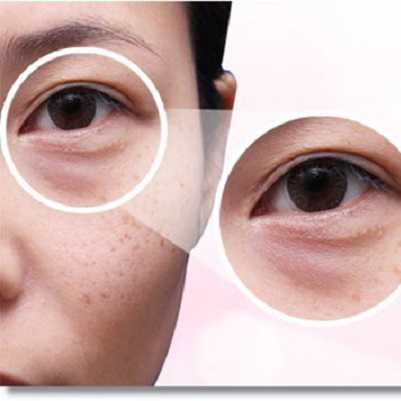 Tại BVTM Kangnam, phẫu thuật cắt bọng mắt giá bao nhiêu tiền?