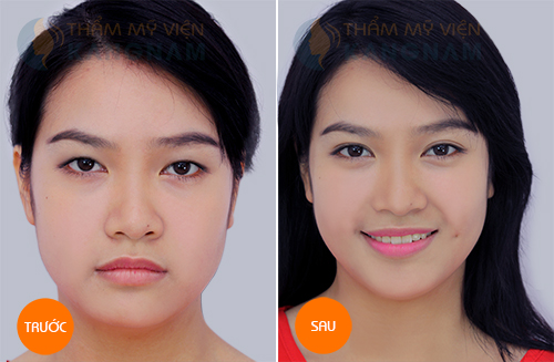 phau thuat mat 2 mi deu dep va vinh vien