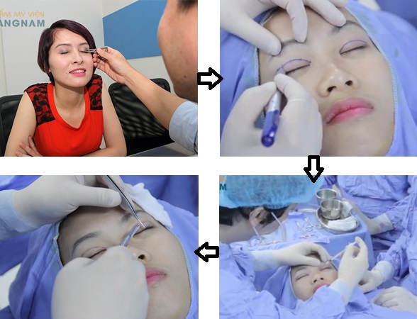 Phẫu thuật mắt 2 mí 