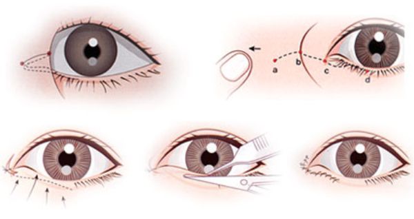 Kỹ thuật thẩm mỹ mắt to khá đơn giản và nhanh chóng1