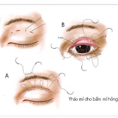 Bấm mí tháo ra được không? Tháo chỉ nhấn mí được thực hiện ra sao?