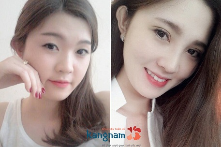 Bấm mí mắt Multi Point – Giải pháp tạo mắt 2 mí tốt nhất 2017